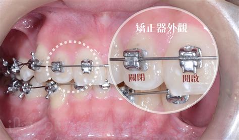 方形矯正線作用|什麼是固定矯正裝置中最好的初期矯正線？ 